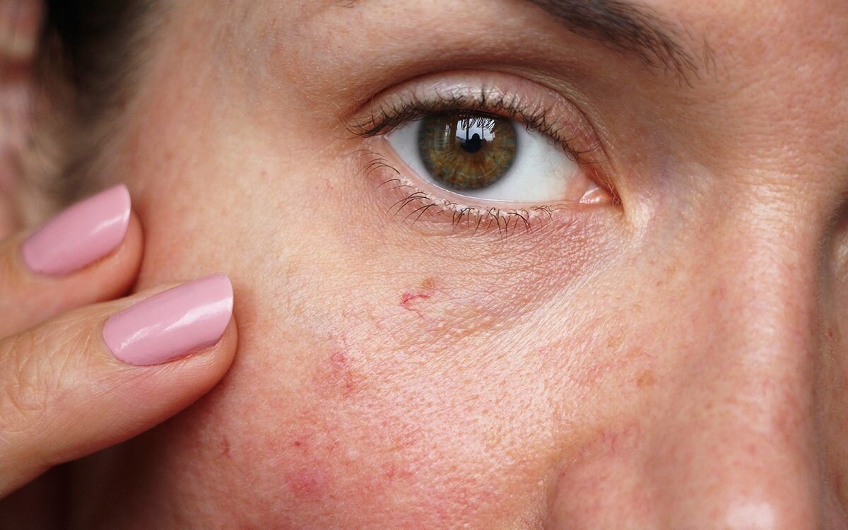 Sensitive Skin Treatments