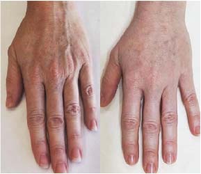 Before Skin Boosters