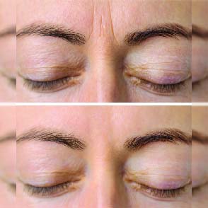 After Botox Treatment