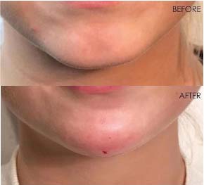 Chin Treatment 1