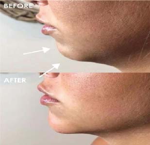 Chin Treatment 2