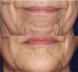 Chin Treatment 3
