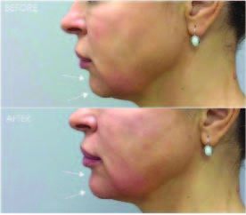 Chin Treatment 4