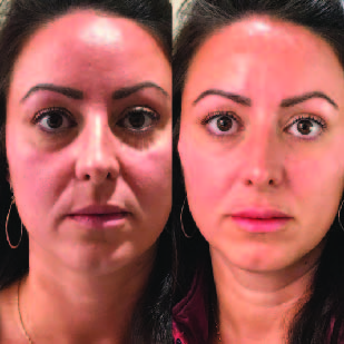 Before Facial Contouring