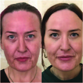 After Facial Contouring