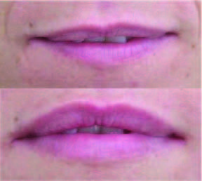 Before Lip Enhancement