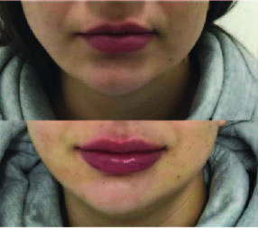 Lips 3