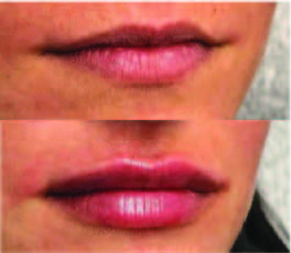 After Lip Enhancement