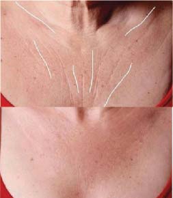 Neck Treatment 2