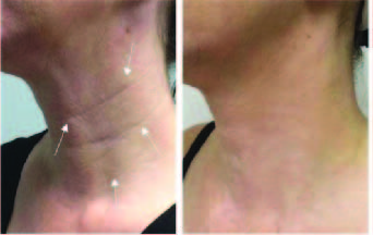 Neck Treatment 4